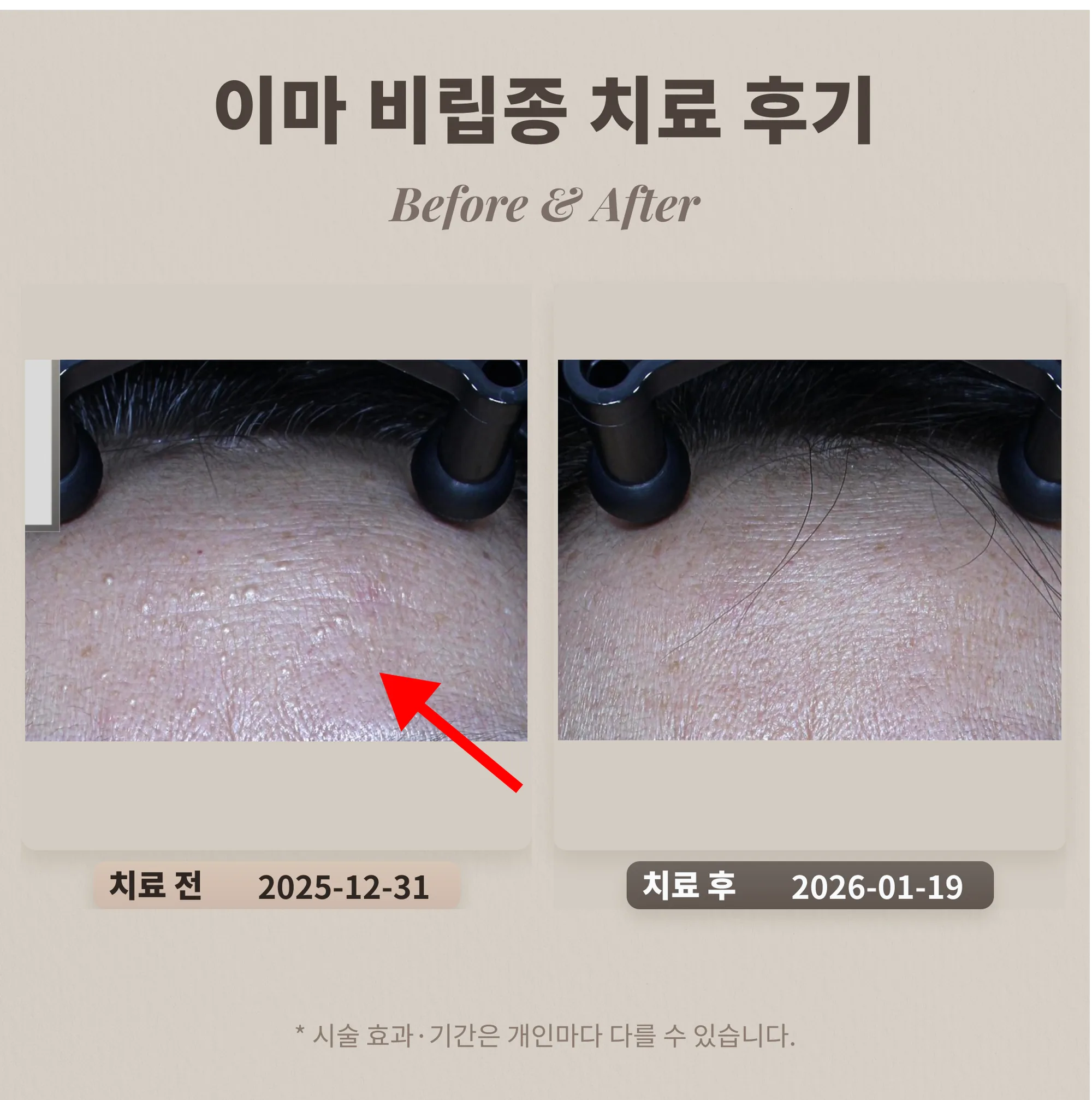 이마 비립종 치료 후기