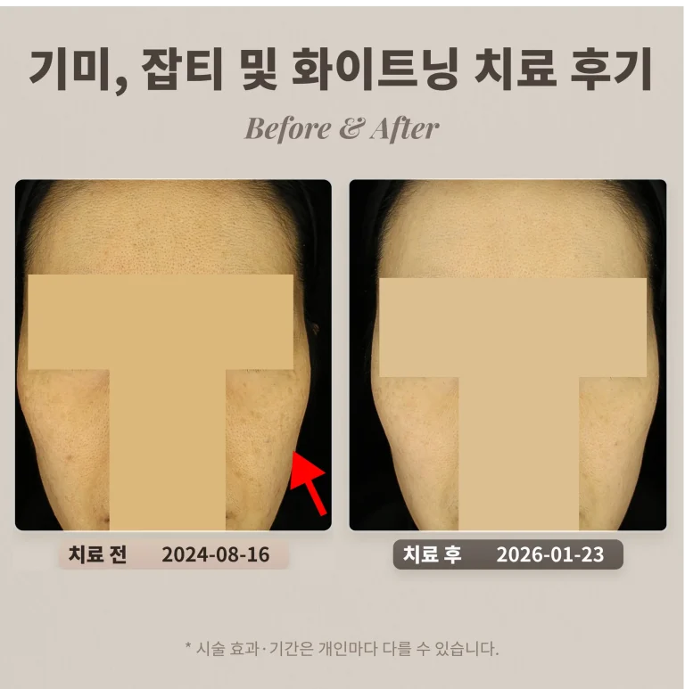 기미, 잡티 및 화이트닝(토닝) 치료 후기