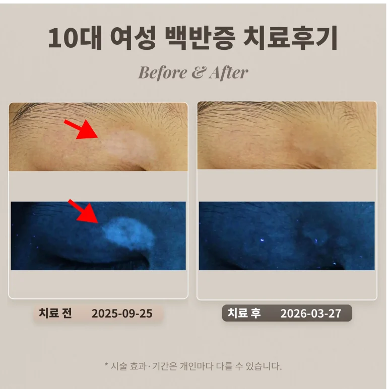 10대 여성 백반증 치료후기