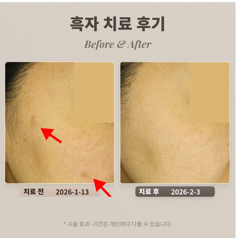 40대 여성 흑자 치료 후기