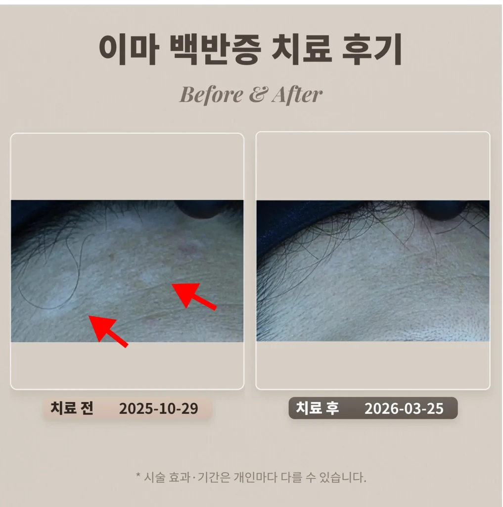 이마 백반증 치료 후기