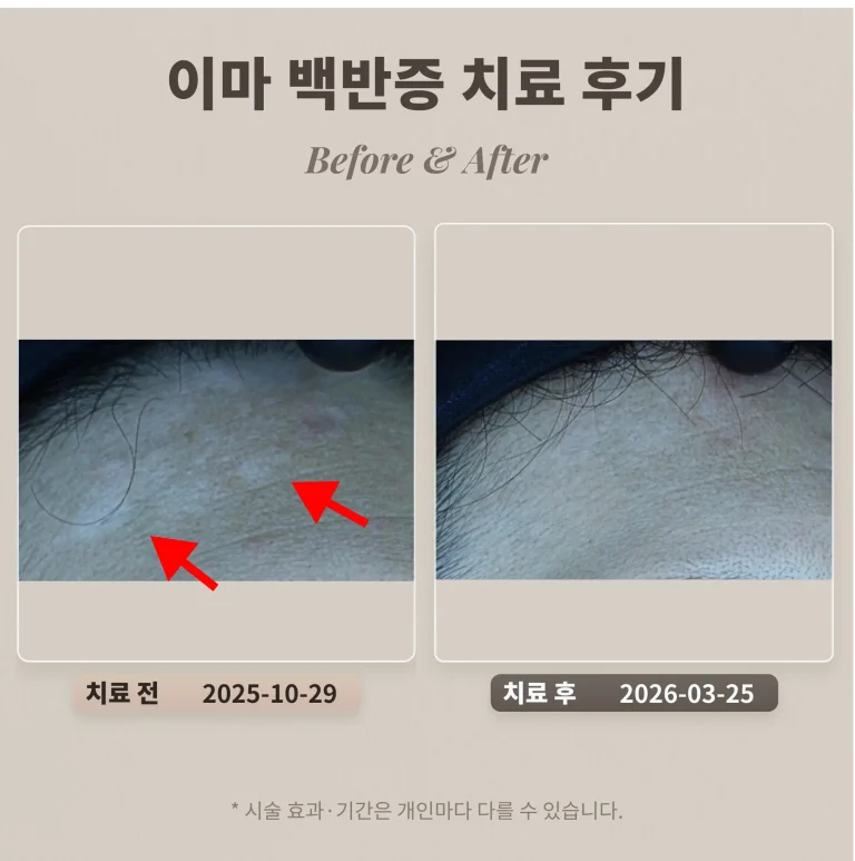 이마 백반증 치료 후기