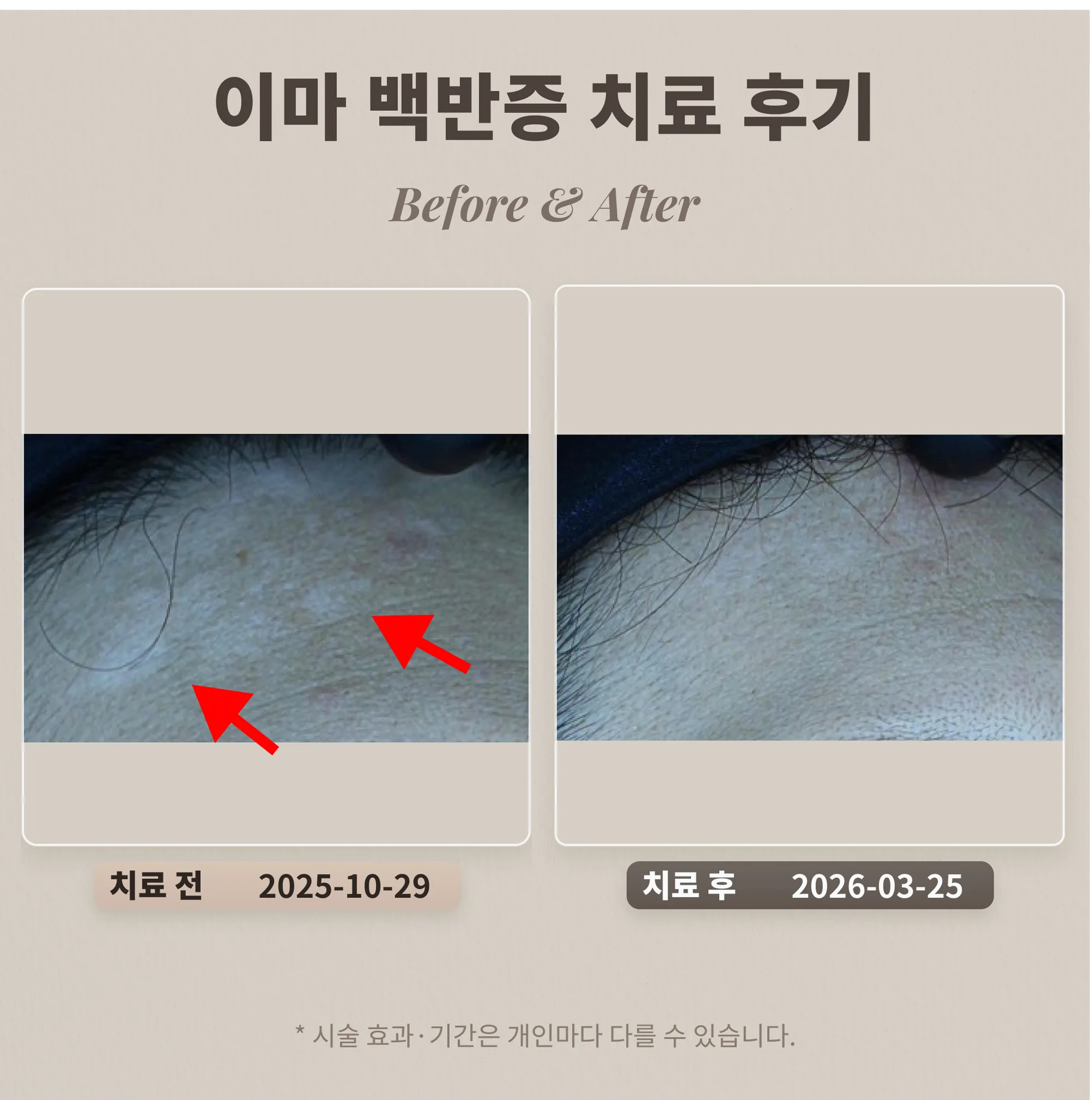 이마 백반증 치료 후기