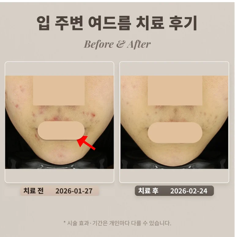 입 주변 여드름 치료 후기