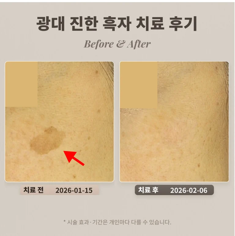 광대 진한 흑자 치료 후기